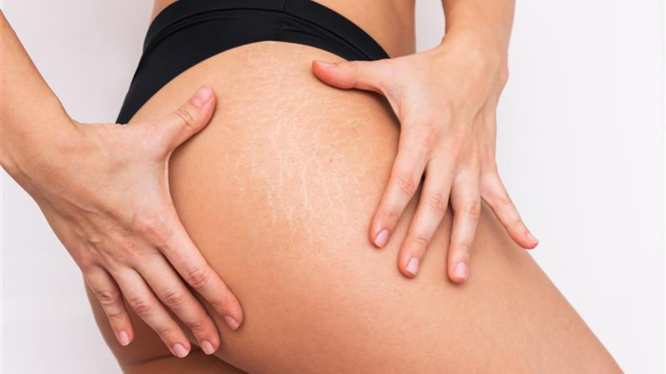 Stretch Marks & Scars